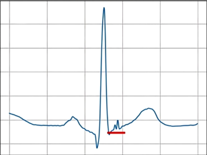 Examples of cardiac cycle with ventricular late potential